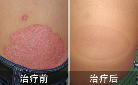 东方治疗银屑病的康复案例